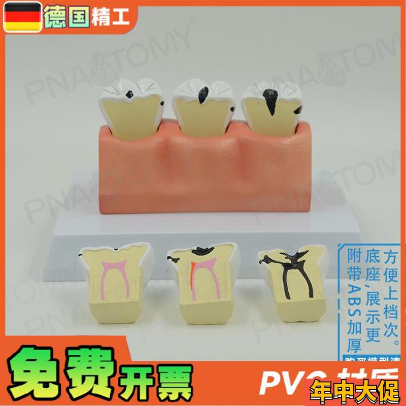 德国】牙科牙齿龋齿解剖分解模型口腔科牙科病理蛀牙模型 教学展