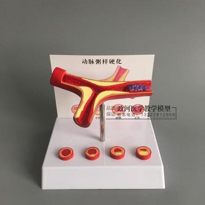冠状动脉性心血管动脉硬化模型老年心脏U模型血栓形成