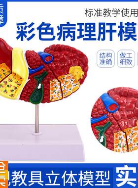 彩色肝脏模型常见临床病s理特征医生用医患沟通硬化脂肪炎肝胆内