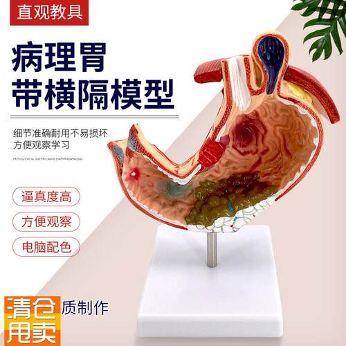 人体胃模型病变胃模型带横隔胃疾D病演示病理胃溃/疡胃解剖模型