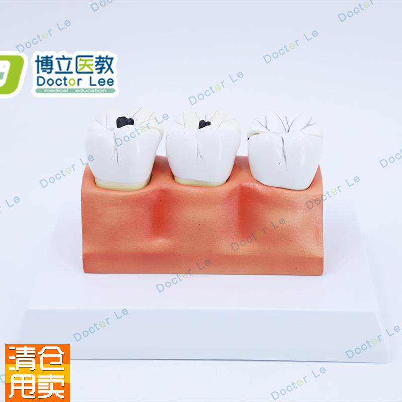教学仿真龋齿模型牙齿模型病变牙齿模型K3颗龋齿模型龋齿分解模型