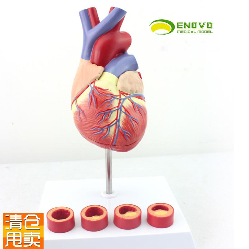 ENOVO颐诺1:1医学人体心脏模D型冠状动脉血栓心内科教学动脉粥样
