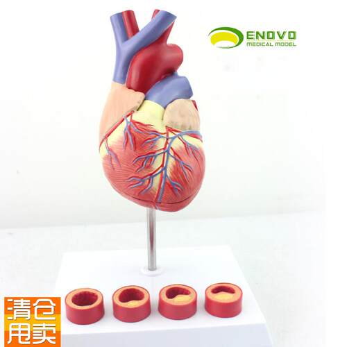 ENOVO颐诺1:1医学人体心脏模D型冠状动脉血栓心内科教学动脉粥样