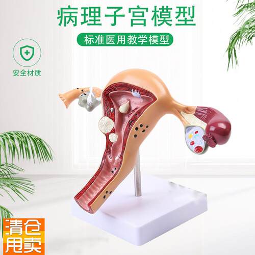 人体模型女性生殖子宫阴道卵巢子宫教学模具N病理变化科普培训教