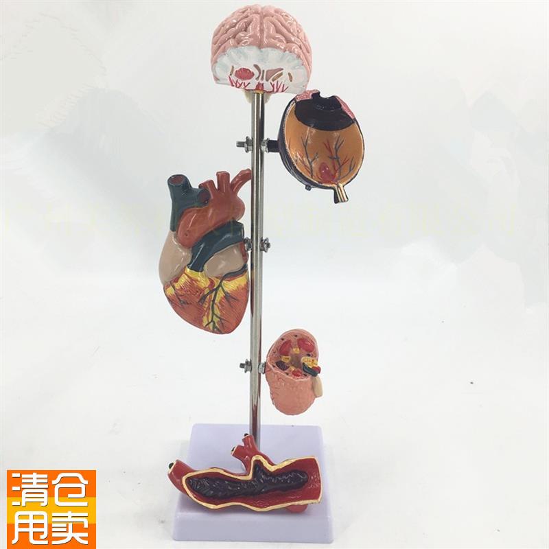 高/血压模型5部分血压病理变脑眼心脏肾脏血Z管内脏模型