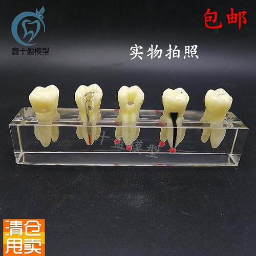 口腔教学模c具水晶根管治疗模型可拆修复牙冠龋齿蛀牙病理M4012