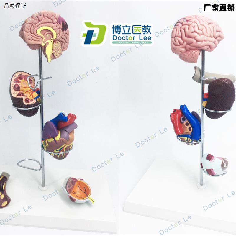 进口人体高血压模型O并发症心脏模型肾脏模型眼睛模型脑模型