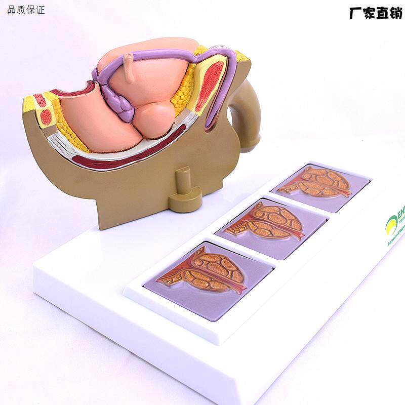 ENOVO颐诺人体男d性前列腺模型前列腺增生肥大模型BHP模型