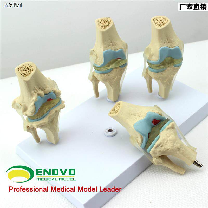颐诺正品人体病理膝关节模型血友病退行性膝关节病S发炎膝关节模