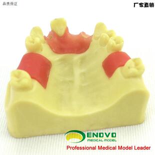 ENOVO正品牙医口腔种植培训上颌骨k缺失牙齿科种植体操作练习模型