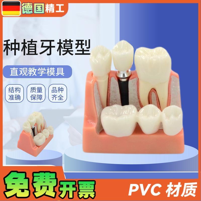 德国】种植牙模型 人体口腔牙齿模型K透明牙模型 牙种植模型