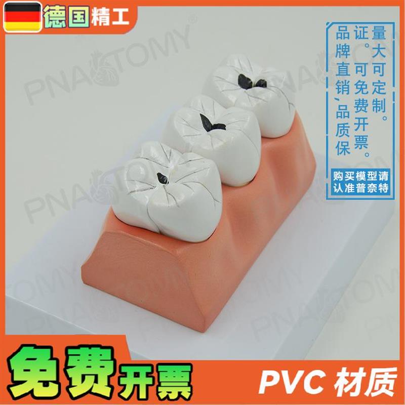 德国】牙科牙g齿龋齿解剖分解模型口腔科牙科病理蛀牙模型 教学展