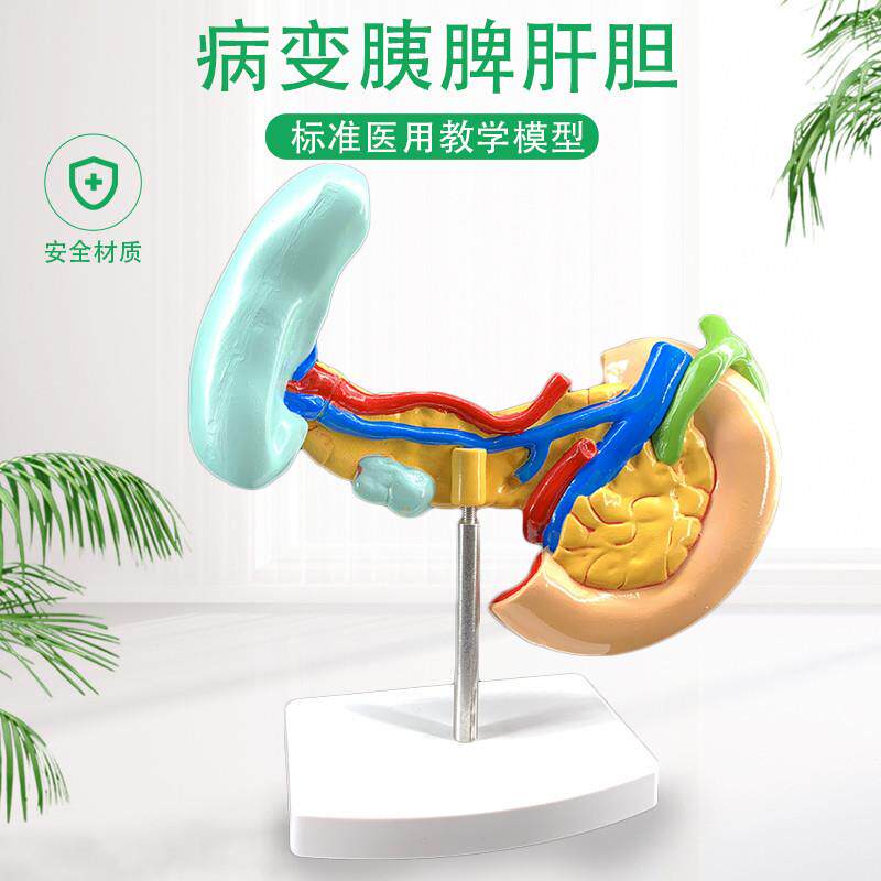 病变胰脾b肝胆十二指肠模型病理标本胰脾肝胆人体器官解剖教学模