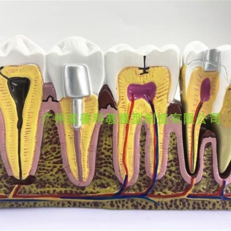 牙科口腔6倍综合病理模型 龋齿解剖根管L及牙神经展示教学模型