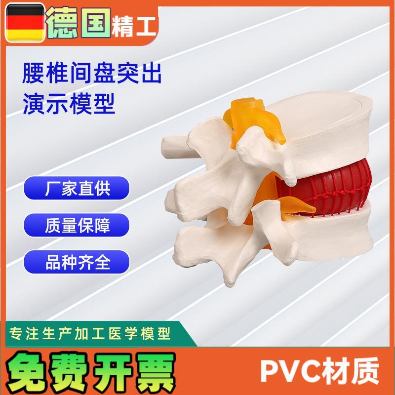 椎间盘模型人体腰椎突出病理演B示模型11*10*7.6CM