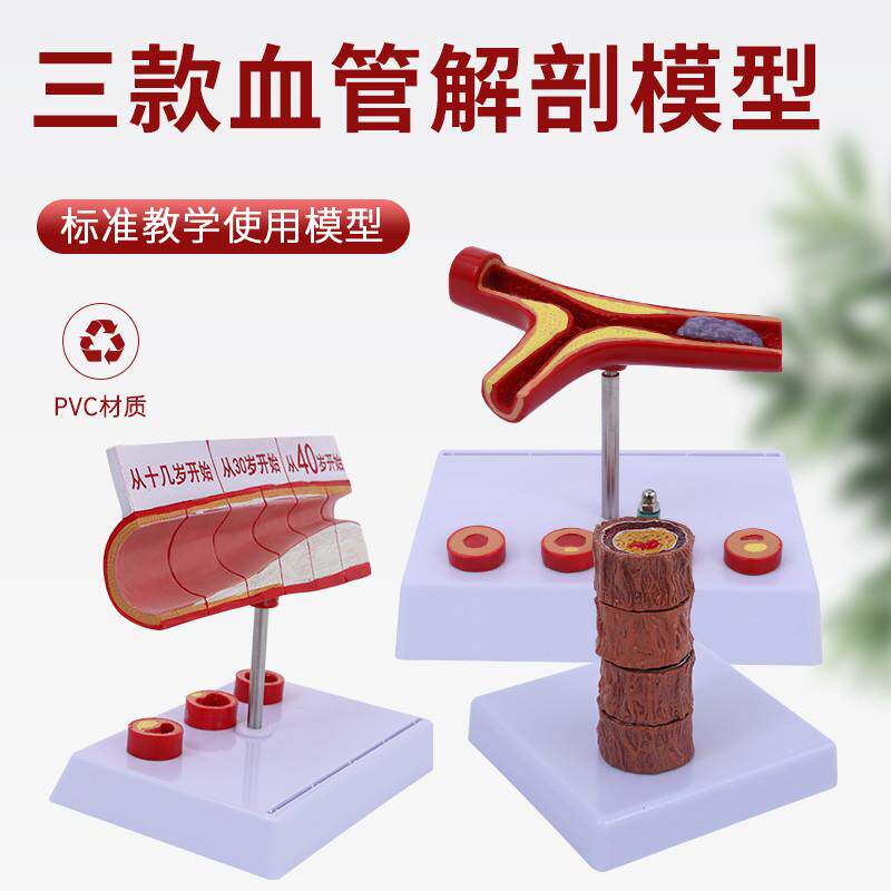 4阶段硬化动脉病理血管模型 病 冠心 人体病态血T管 血管解剖模型