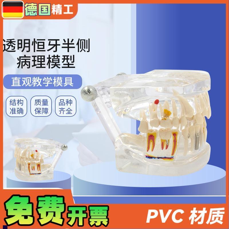 德国透明恒牙半侧病理模型综合A病理牙模型可拆卸牙模种植体修复