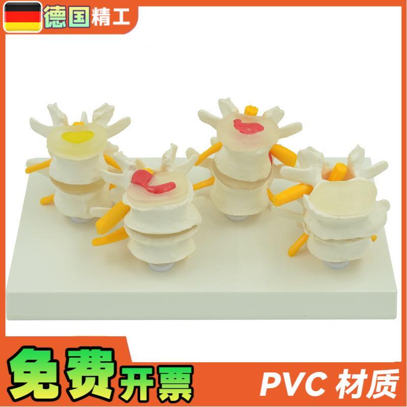 德国】4阶段病变m腰椎模型 人体骨骼解剖椎体医学教学器材