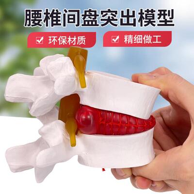 腰椎放大腰椎间盘受压演示模型人体脊柱脊L椎骨病理椎间盘膨出模