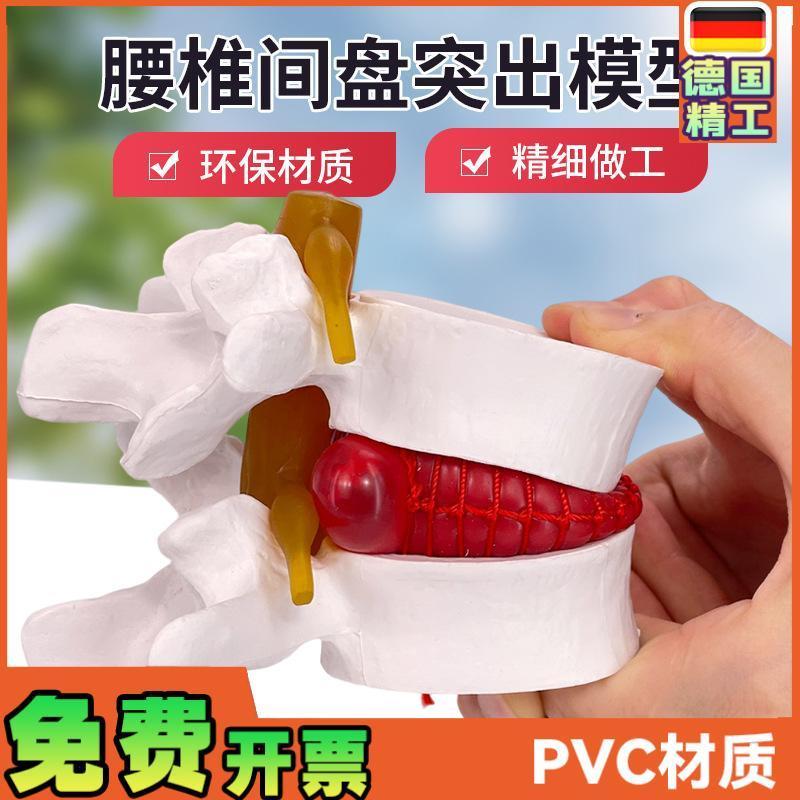 腰椎放大腰椎间盘j受压演示模型人体脊柱脊椎骨病理演示关节医学