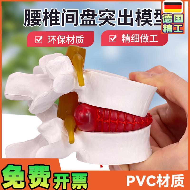 腰椎放大腰椎间盘受压q演示模型人体脊柱脊椎骨病理演示关节医学