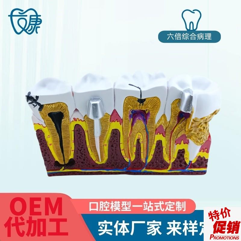 综合病理模型成i人牙周切面牙齿模型病理牙神经口腔牙科教学摆件