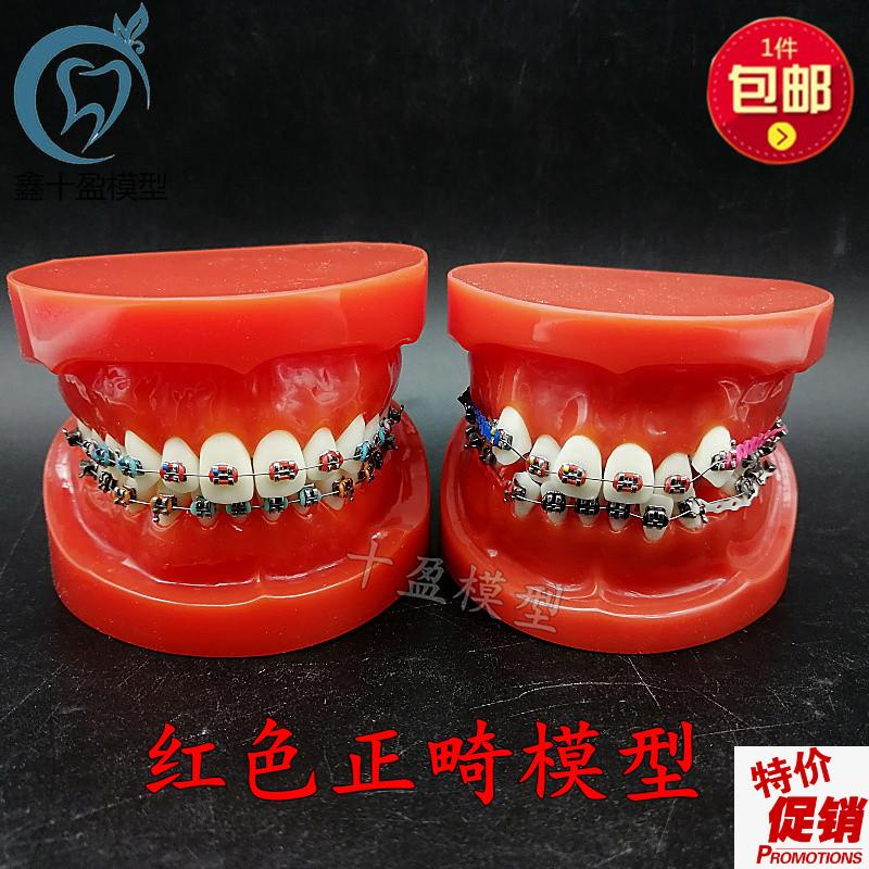 口腔牙列整齐正畸模型红牙列不齐错颌缺失牙齿仿R真牵引皮链支抗