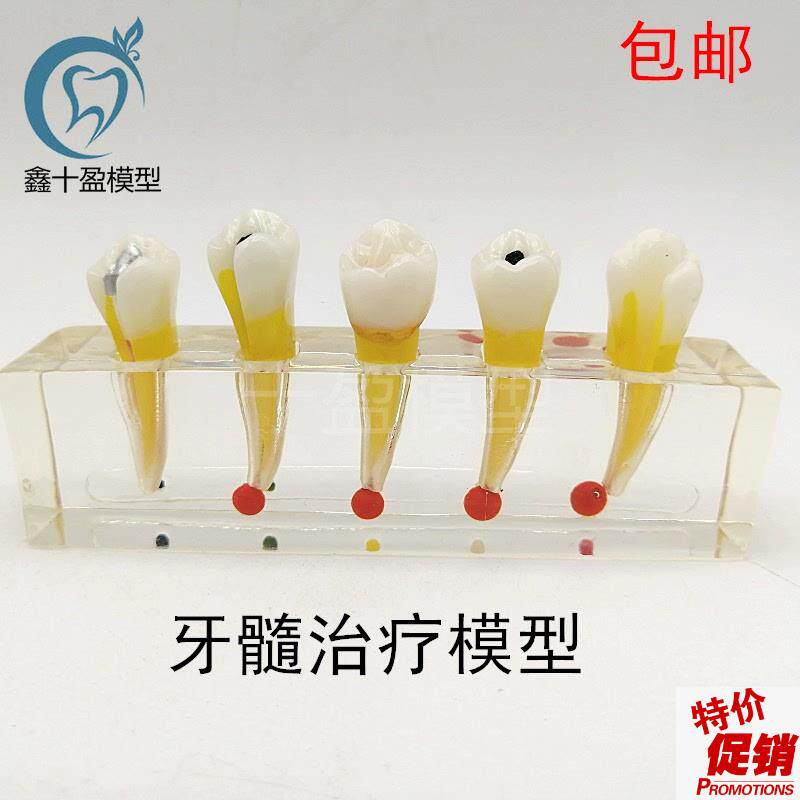 牙科口腔牙齿模型牙髓修复模v型前磨牙牙体蛀牙根管龋坏M4007-2