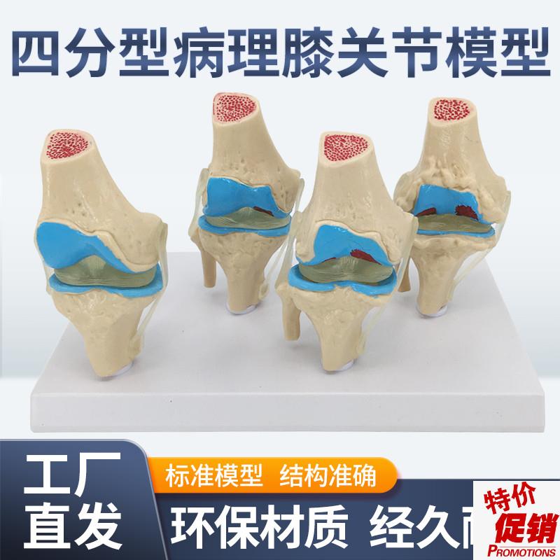 病变膝关节骨骼模型骨科教学展示膝盖退行性增生骨h质病理膝关节