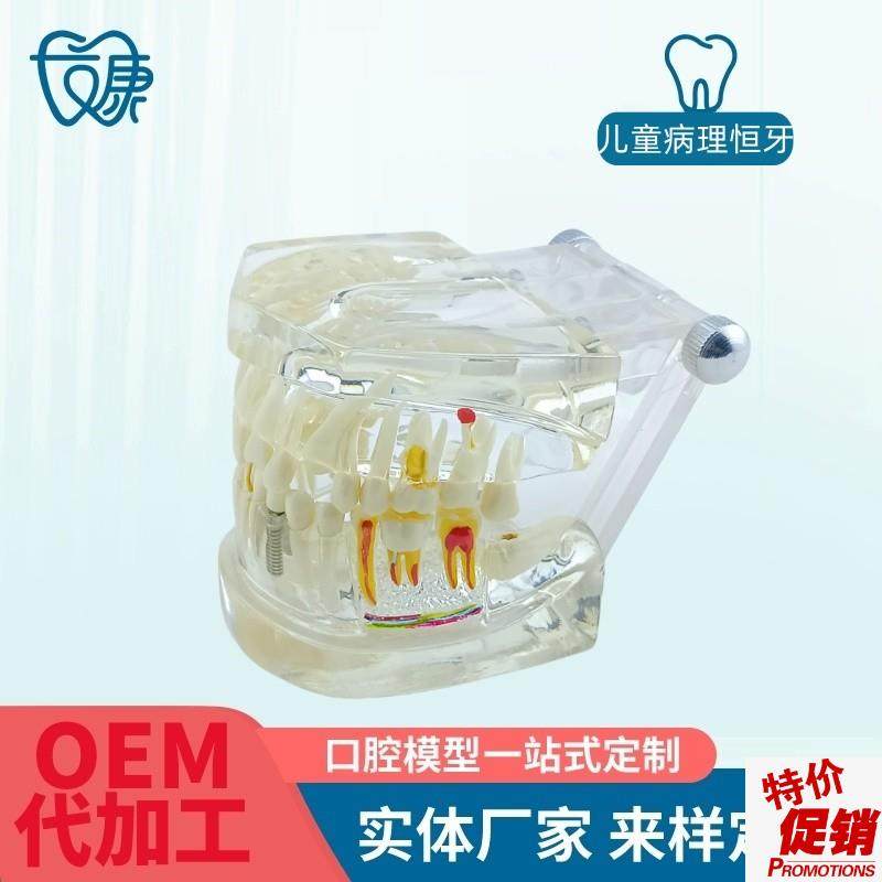 牙齿模型病d理修复可拆卸正畸口腔病理牙模型牙科医患活动沟通