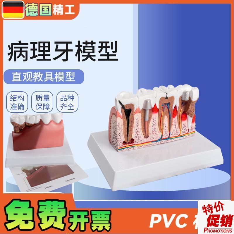 德国】病理牙模h型成人病理牙齿模型口腔模型牙科教学模型演示模