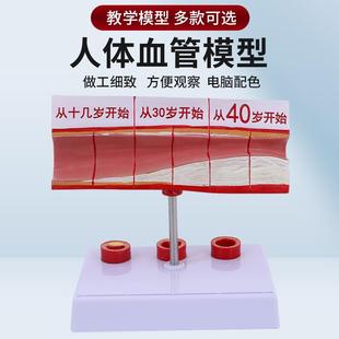 人体梗化支脉粥样心血管动脉B解剖梗化模型血管血全形成模型