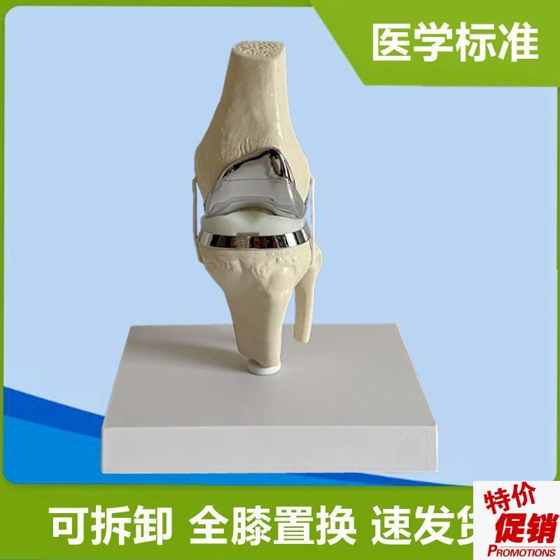 膝关节置换人工假肢替换半月板z胫骨软骨膝盖手术演示临床骨科教