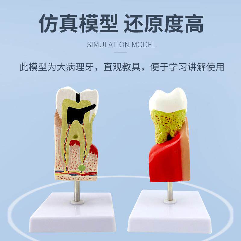 蛀牙模型牙齿病综合病理模型牙齿解剖剖面R模型齿科医患沟通