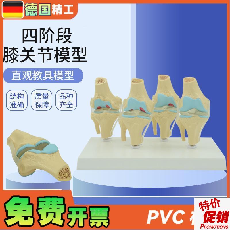 德国】人体膝关节模型正常与病理对比教具M医药礼品医患沟通道具
