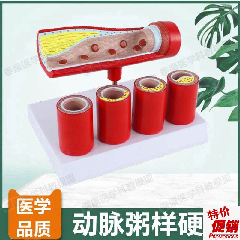 动脉血管模型内膜k粥样斑块阻塞狭窄硬化医患药礼品血管壁层次解