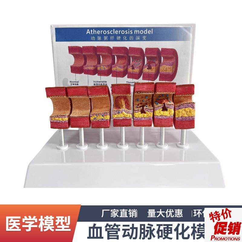 7节动脉粥样硬化模n型血管血栓栓塞演示模型人体血管模型医用教具,玩具/童车/益智/积木/模型,其他模型玩具,淘宝优惠券,粉丝福利购,淘宝优惠卷