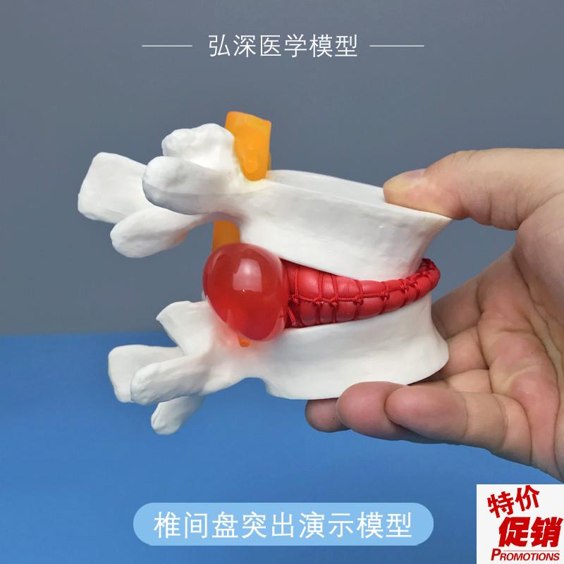 腰椎间盘突e出演示模型人体脊柱放大脊椎挤压展示教学医患讲解道