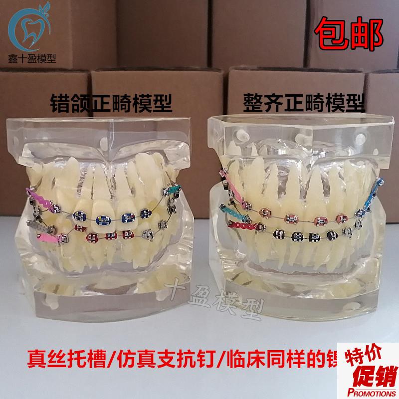 错颌矫正展示扎丝托n槽正畸牙齿模型牙模牙科模型牙齿模型口腔模