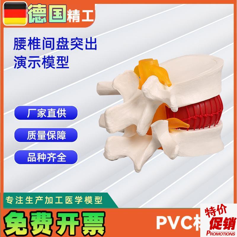 椎间盘模型人体腰椎突出病理演示模型11*10X*7.6CM
