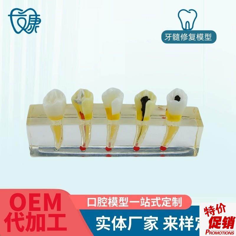 牙科医患沟通病理模型牙髓病修E复模型展示牙髓牙髓治疗模型