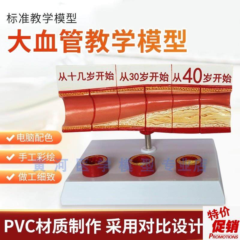 血栓模型人体支脉粥样硬化动脉心血管各阶段年龄血Z管展示模型