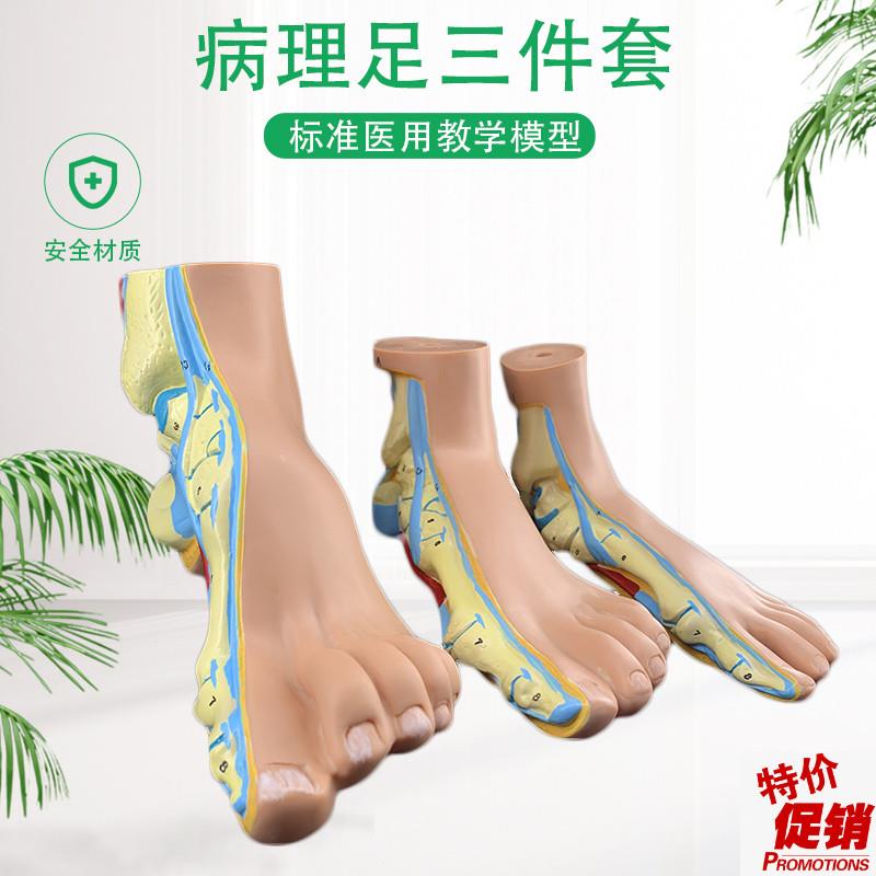 正常足弓形足高弓足模型脚x关节模型爪形足脚部模型解剖医院
