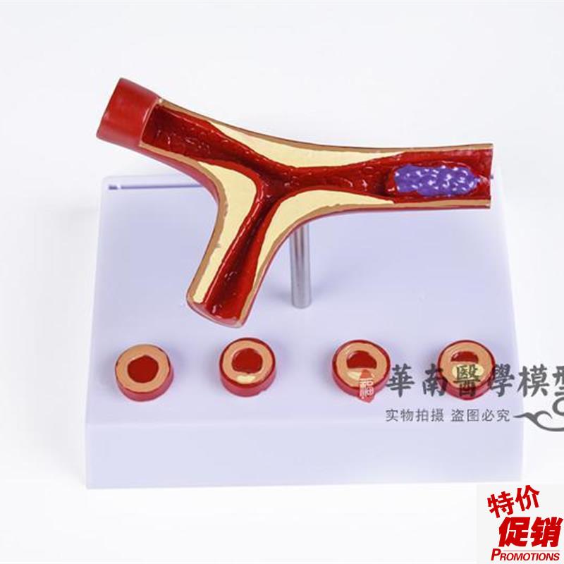 人体支脉粥样f=硬化血栓=形成=模型血管模型血液科动脉=化模型