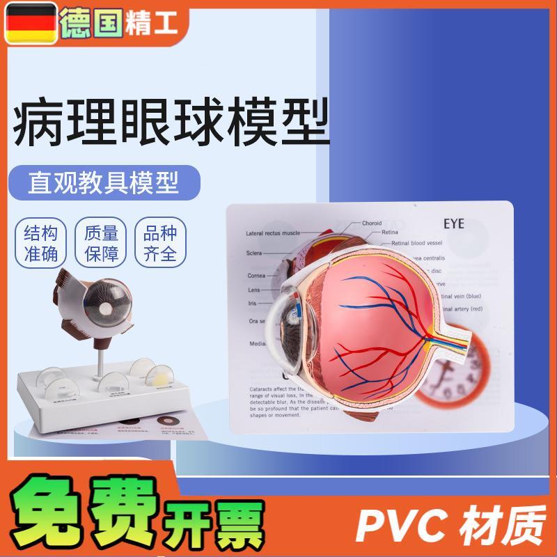 德国】病理眼球模型眼s球模型角膜病变眼球模型医学教学教材模