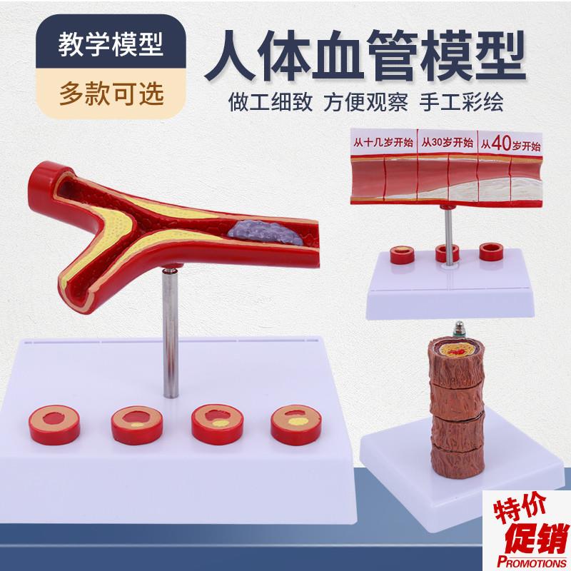 血管堵塞动支脉粥样硬化心血管模型堵塞程度Q变化病理血管模型