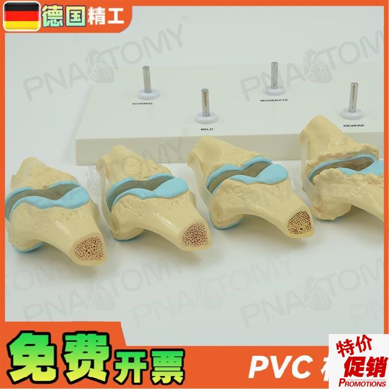 德国】人体膝关节骨骼/病理模型关节骨质/病变教学膝.盖骨外科疼