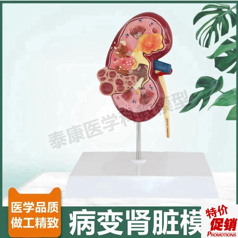 人病理肾脏模型泌尿系统蛋白尿肾小球肾单位尿液肾上X腺内分泌腺