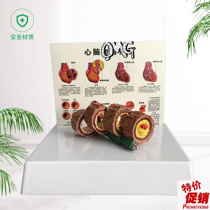 教学仿真血c管模型活动血管阻塞模型血栓病变标本4阶段性动脉O硬