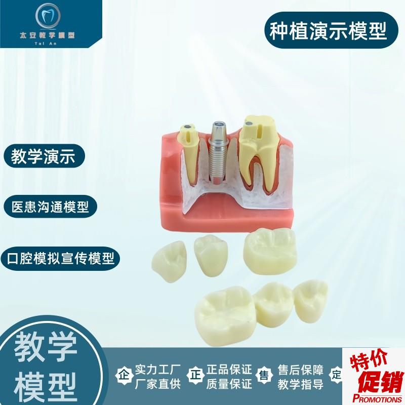 牙科口腔种植模型演示模型医患沟通教学T练习种植牙模型